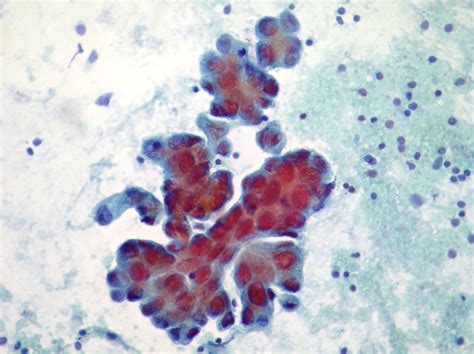 Cytopathology of lymph nodes-FNAC | Cellnetpathology