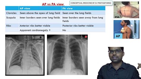 PA Chest X Ray