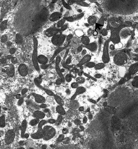 Electron Microscopy From Myocardial Biopsy This Representative