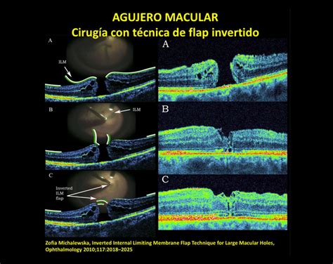 Agujero Macular Somos Retina Y M Cula Consultores