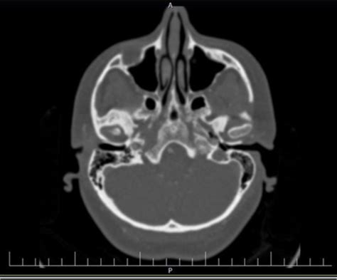 High Jugular Bulb And Jugular Bulb Dehiscency In Left Side Bone