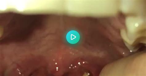 Draining My Tonsil Abscess Album On Imgur