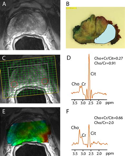 In Vivo Assessment Of Prostate Cancer Aggressiveness Using Magnetic