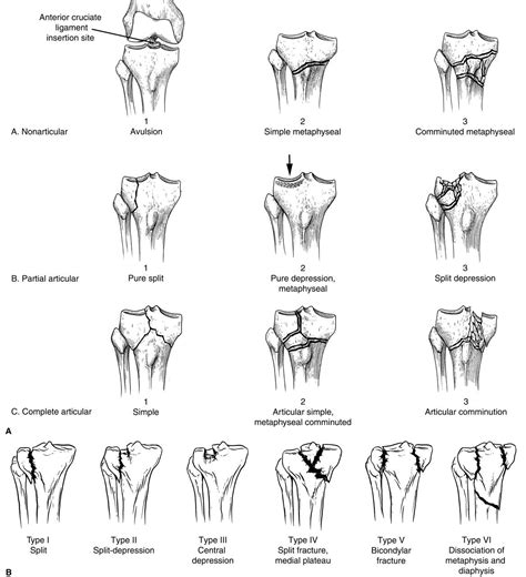 A Tibial Plateau Fracture Is A Bone Fracture Or Break In The Continuity