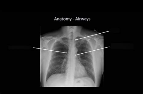 XRAY Airways Diagram Quizlet