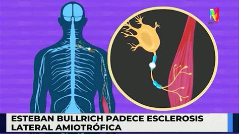 Qu Es La Esclerosis Lateral Amiotr Fica Ela Y Como Se Diagnostica