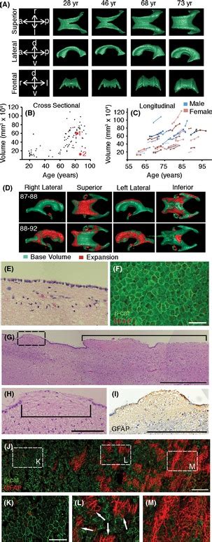 Increased Ventricle Volume And Periventricular Gliosis Are Typically Download Scientific