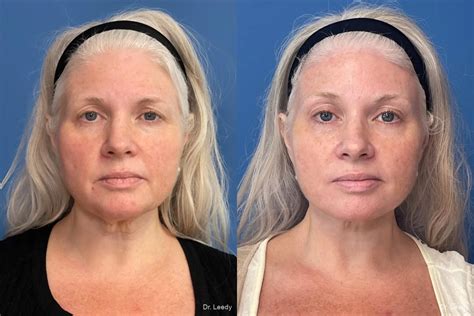 Facial Rejuvenation Before After Gallery