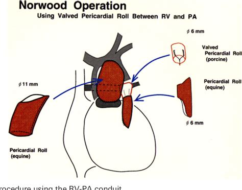 Figure 1 From Modified Norwood Procedure Using A Right Ventricle To