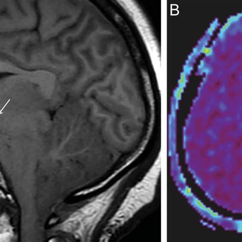 Diffuse Cerebral Edema And Increased Intracranial Pressure Causing Download Scientific Diagram