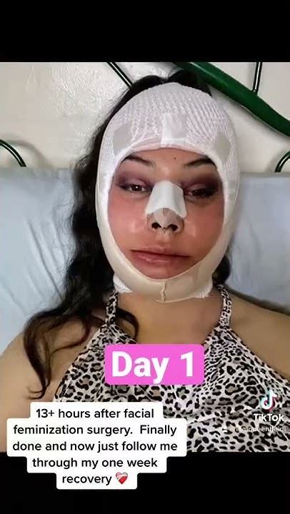 Day 1 Of Facial Feminization Surgery Ffs Recovery Youtube