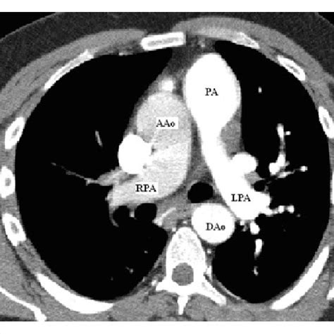 Right pulmonary artery (RPA), left pulmonary artery (LPA), pulmonary ...