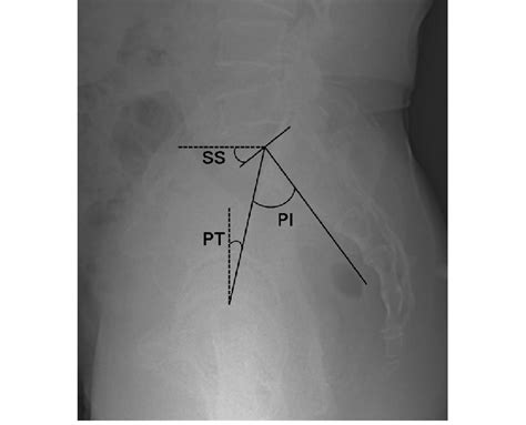 Radiograph Showing The Measurement Of Pelvic Parameters Pelvic Download Scientific Diagram