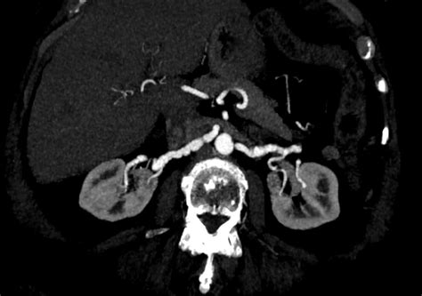 Fibromuscular Dysplasia Renal Arterial Involvement Image