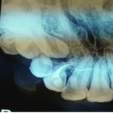 Upper Occlusal Radiograph After 3 Months Root Canal Treatment Download Scientific Diagram