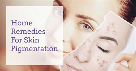 Melasma - Effective Home Remedies And Natural Treatments