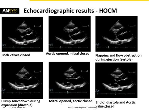 Simulations Of Hypertrophic Obstructive Cardiomyopathy Hocm In A Hu…