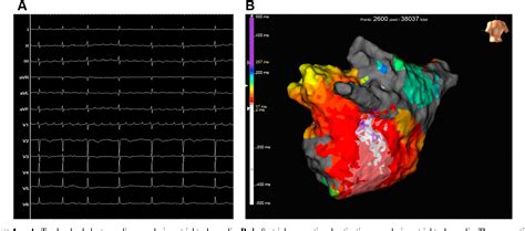 Figure 1 From Identifying The Origin Of Atrial Tachycardia In The