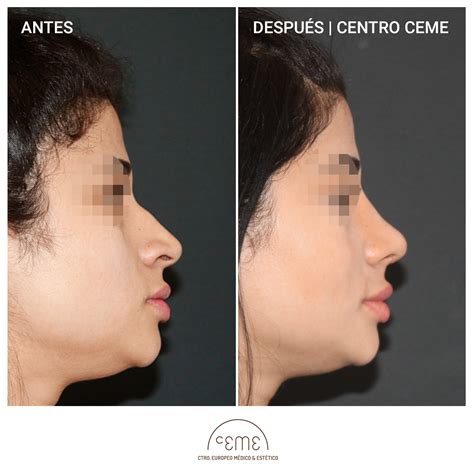 Rinoplastia Ceme