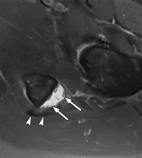 Imaging Of Muscle Injuries In Sports Medicine Sports Imaging Series Radiology