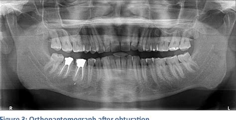 Figure 3 From Nonsurgical Retreatment Of A Very Large Periapical Lesion