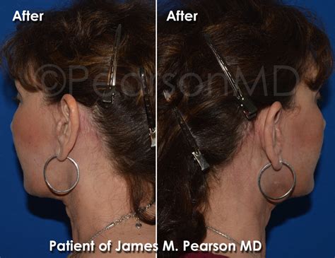 Mini Facelift Dr James Pearson Facial Plastic Surgery