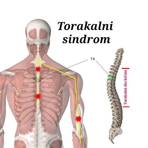 Diskusna hernija Bolovi u leđima kod trudnica Uzroci simptomi i