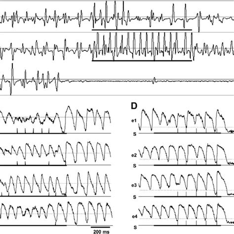 Examples Of Ventricular Tachycardiavf Termination By Sync P The Solid Download Scientific