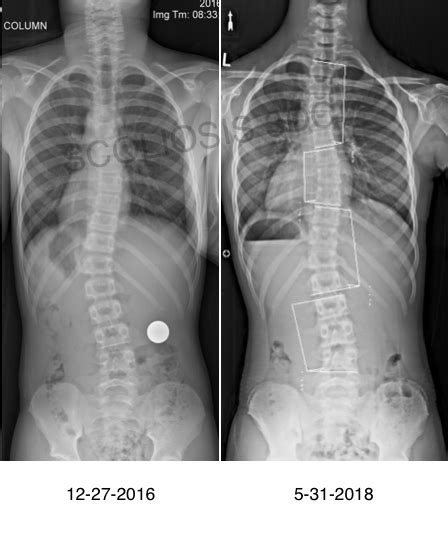 Risser 0 | What is Risser 0 | Risser 0 Scoliosis Treatment