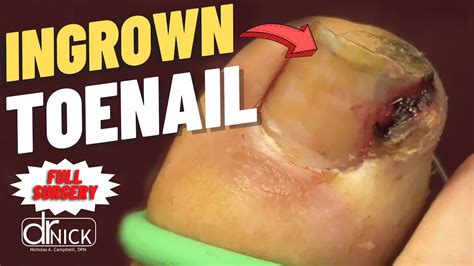 Extreme Closeup Ingrown Toenail Removal Dr Nick Campitelli Youtube