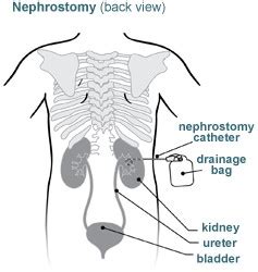 Nephrostomy Tube - Stanford Medicine Children's Health