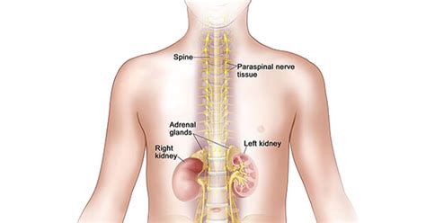 Neuroblastoma—Patient Version - NCI