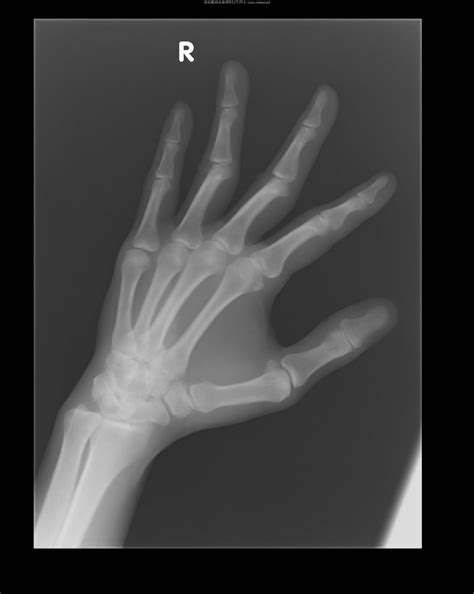 Carpometacarpal Joint Dislocation