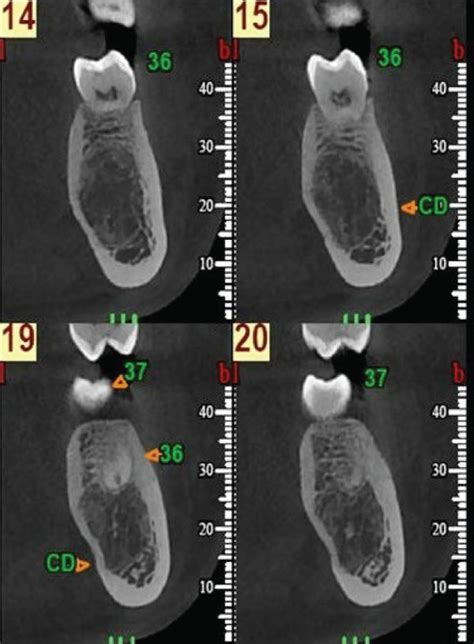 Cone Beam Computerized Tomography Within Months Of Canalization