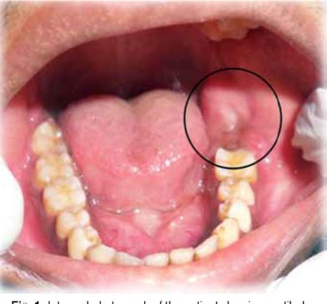 Figure 1 From Unicystic Ameloblastoma A Rare Case Report With