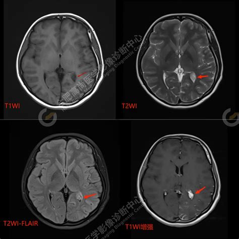 磁共振诊断sturge Weber综合征一例【高尚医学影像】 知乎