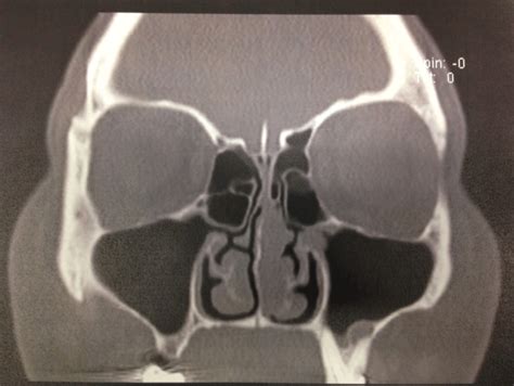 Clinmed International Library Nasal Glomangiopericytoma Case Report