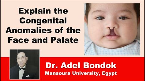 Explain The Congenital Anomalies Of The Face And Palate Dr Adel Bondok