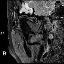 MRI scan showing multiple loose bodies and a cystic intraosseous lesion ...