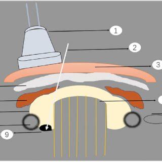 Schematic Diagram Of Ultrasound Guided Percutaneous Thermal Ablation Of