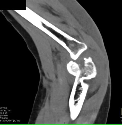 Comminuted fracture causes - chargebool 