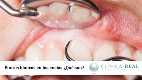 Qué significan los puntitos blancos en las encías Blog Dental Irriak