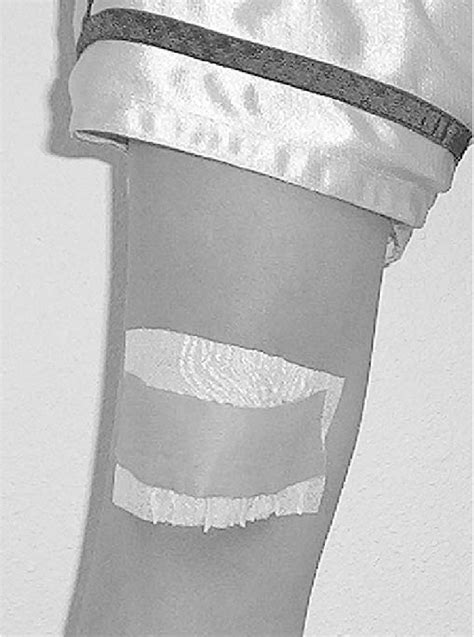 Mcconnell Medial Glide Taping Technique Right Knee Download