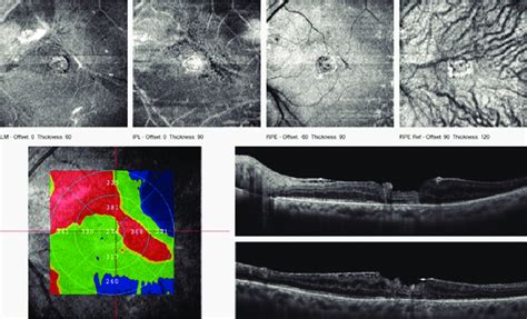 Patient Early Postoperative Oct Cross Line Horizontal And Vertical