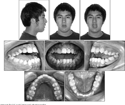 Figure From Extreme Skeletal Open Bite Correction With Vertical