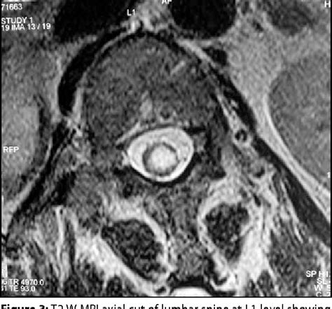 Figure 3 From Epidermoid Cyst Inside Anterior Sacral Meningocele In An