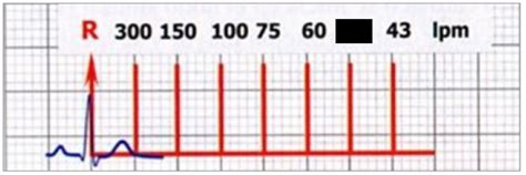 Calcular La Frecuencia CardÍaca En El Electrocardiograma 56 Off