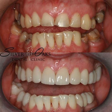 Straighten Teeth Without Braces Silver Oaks Dental Clinic