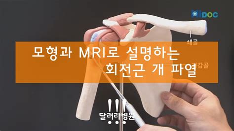 모형과 Mri 로 설명하는 회전근개파열 달려라병원 Youtube