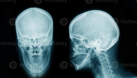 X Ray Skull AP And Lateral View 6755257 Stock Photo At Vecteezy